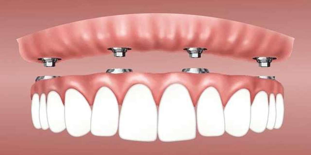 All-Ceramic Crowns and Dental Implants: Integrating Prosthetic Solutions for Tooth Replacement