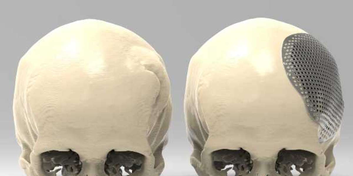 Cranial Implants Market Share, Trend, Segmentation And Forecast To 2030