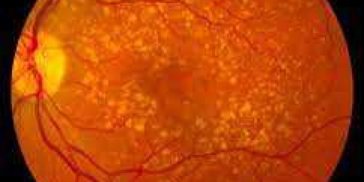 2024 Wet Age-Related Macular Degeneration (Wet AMD) Market | Report By 2034