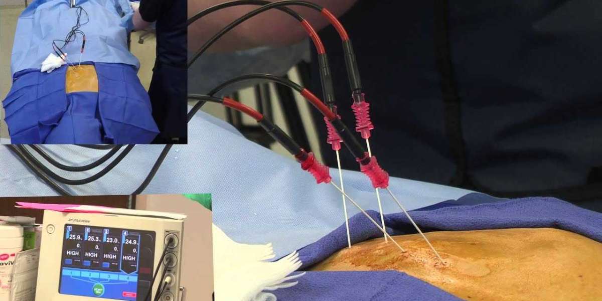 Radiofrequency Ablation Devices Market  Supply, Growth Factors, Latest Rising Trend and Forecast to 2027
