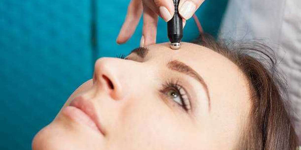 The Marvels of SkinPen Microneedling A Comprehensive Guide