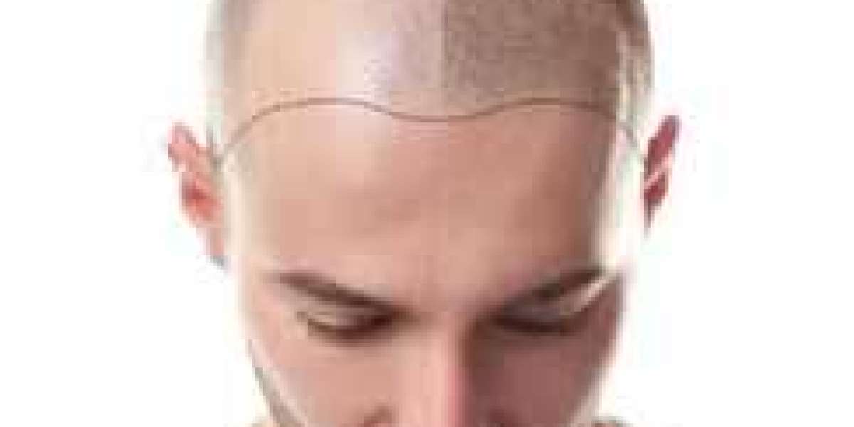 Hairline Harmony: Achieving Natural-Looking Results with Scalp Micropigmentation