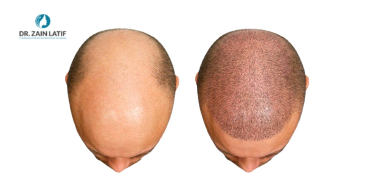 Hair Transplant in Karachi: Is Hair Loss Stealing Your Confidence?