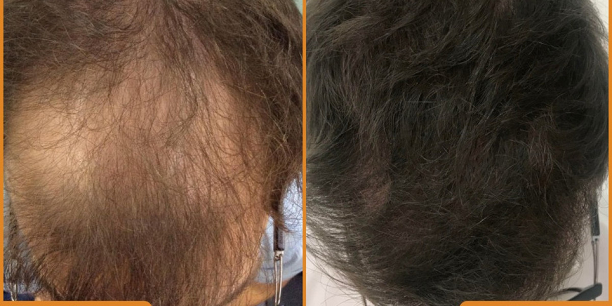 What Are the Key Factors to Consider Before Choosing a Hair Restoration Treatment?