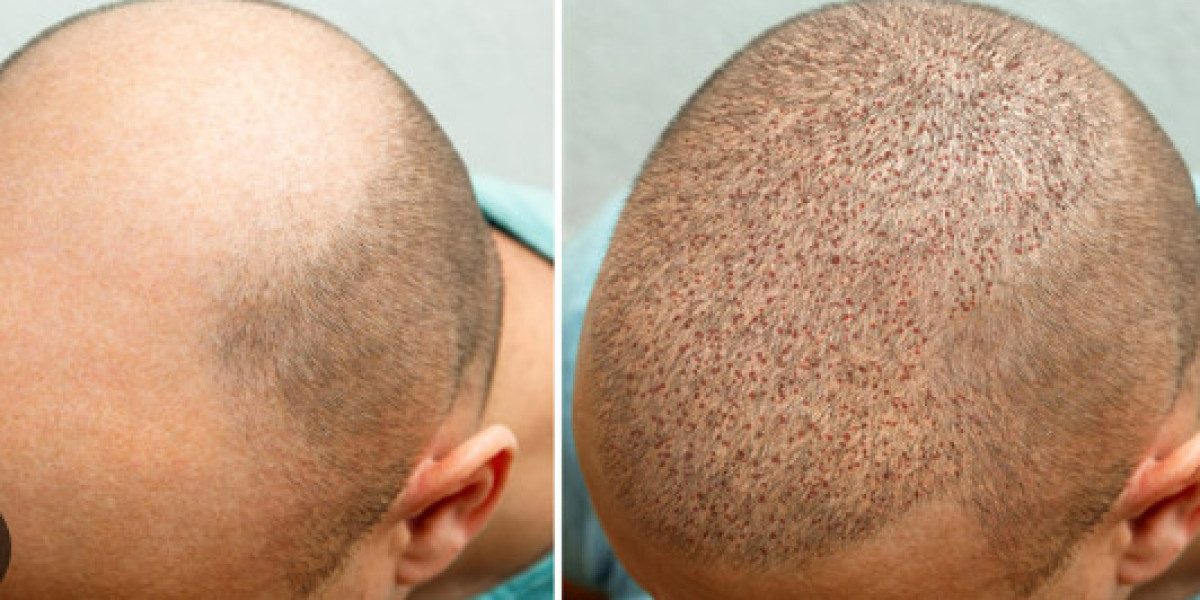 The Ultimate Guide to Finding the Best Hair Transplant Clinic in Turkey