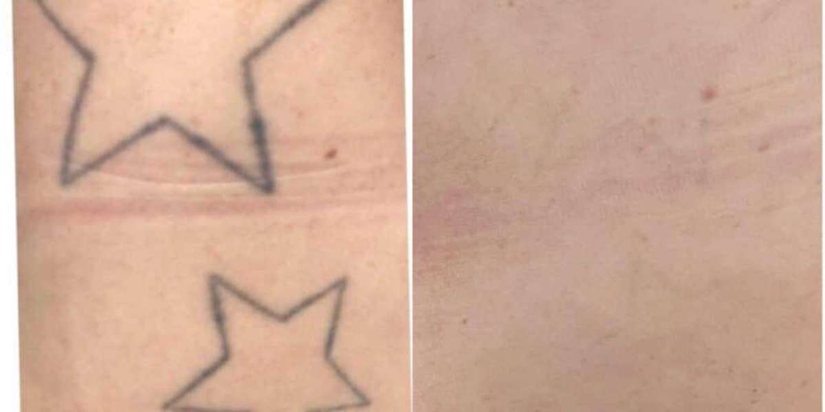 Clearing the Canvas: Understanding Laser Tattoo Removal