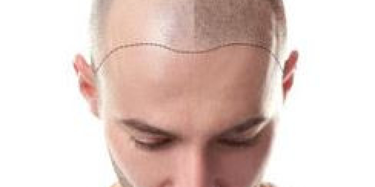 Say Goodbye to Baldness: Scalp Micropigmentation Explained
