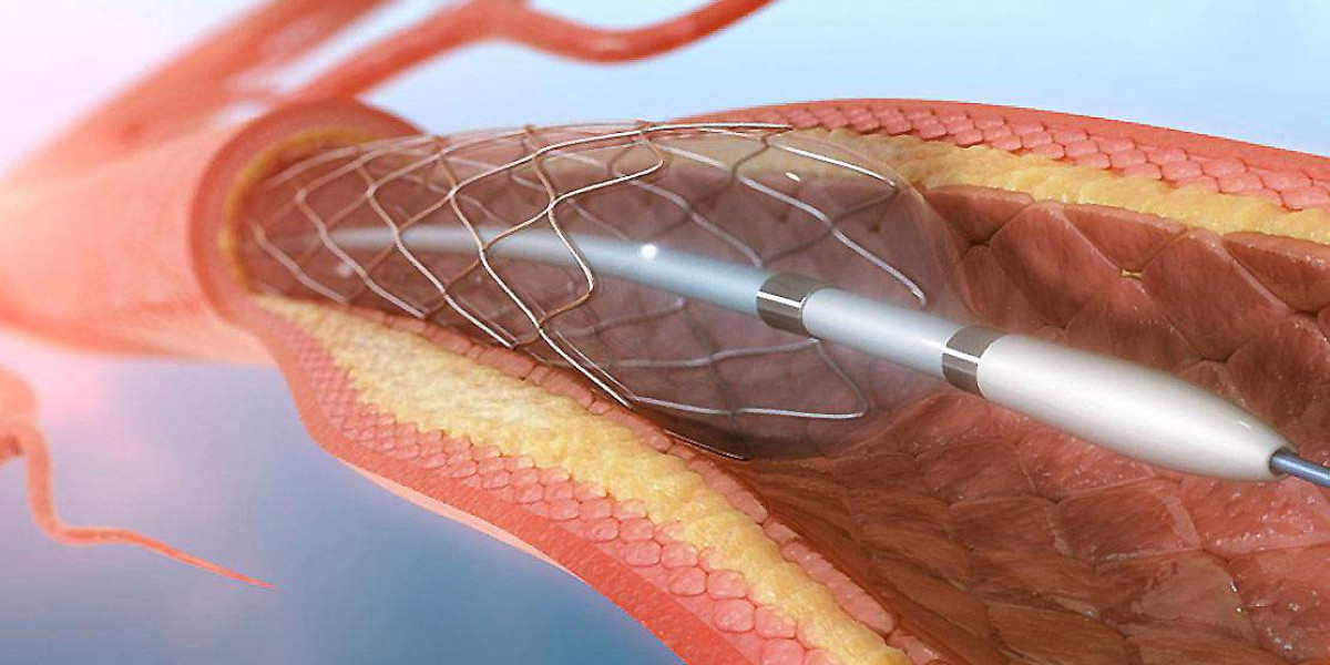 Endovascular Therapy: The Future of Cerebral Vascular Stent Technology