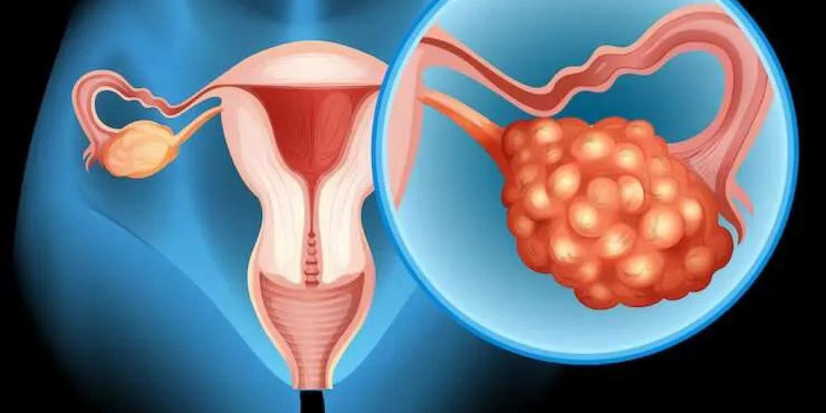 Bulky Uterus And Fertility: Symptoms, Diagnosis, Causes And Treatment by Ritu IVF