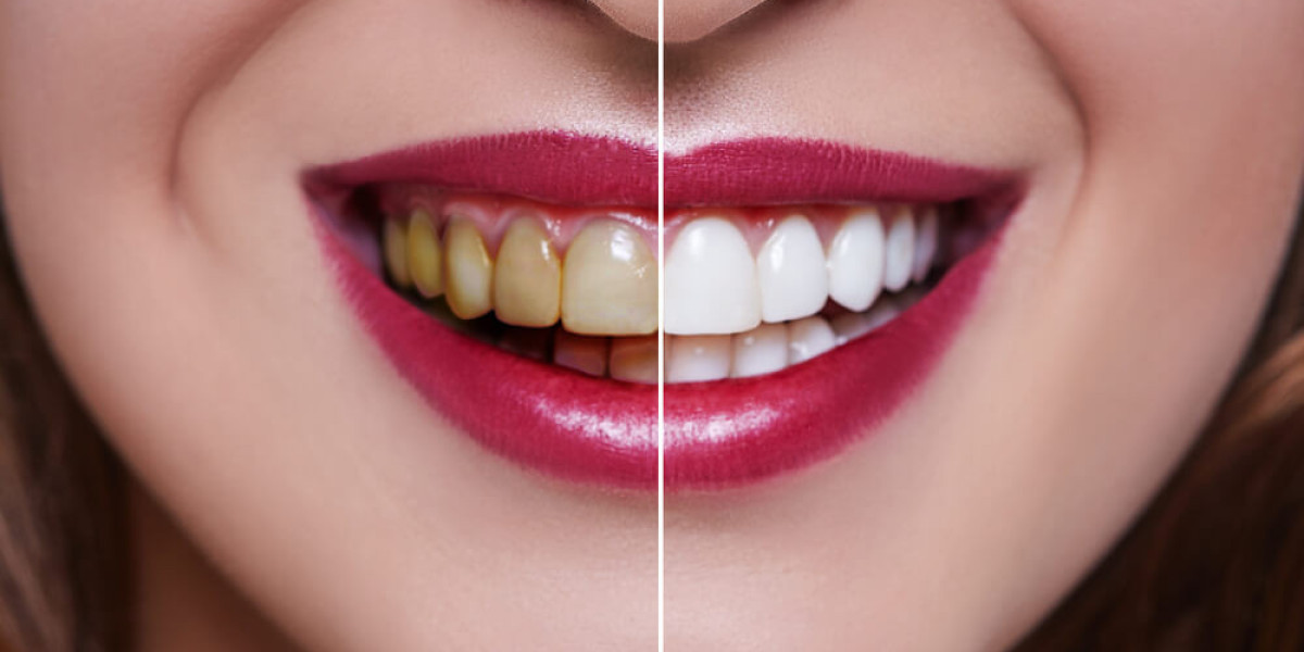 Teeth Whitening Services: Experience The Radiance Of Smiles