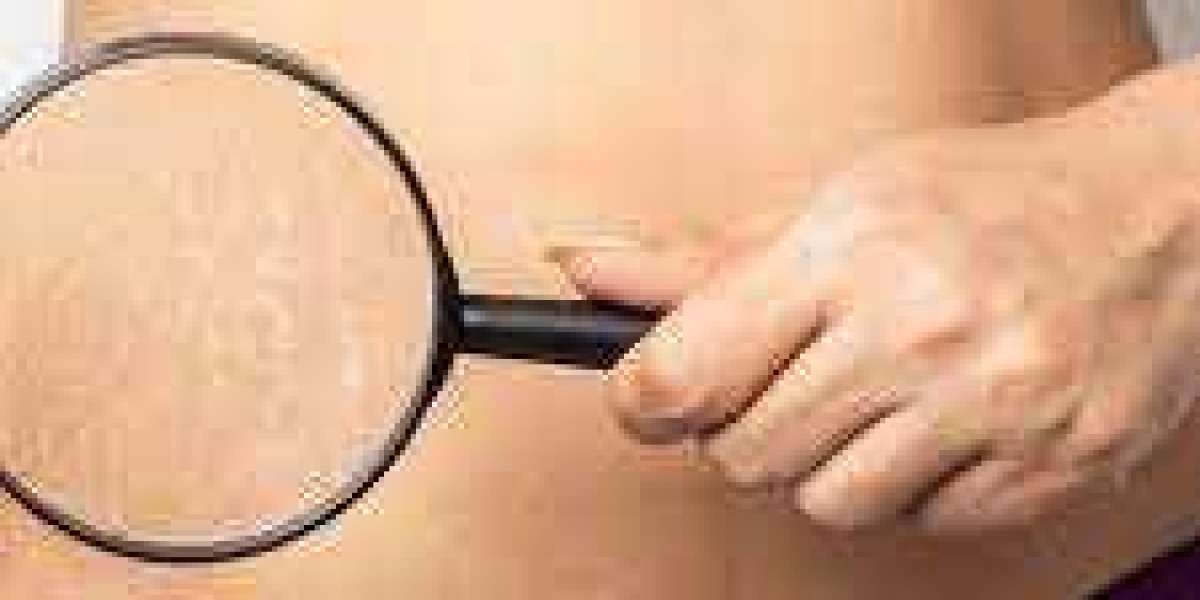 Unveiling the Secrets: Effective Stretch Marks Removal in Dubai