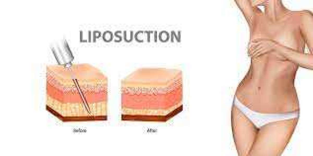 Sculpting Confidence: The Rise of Liposuction Surgery in Riyadh