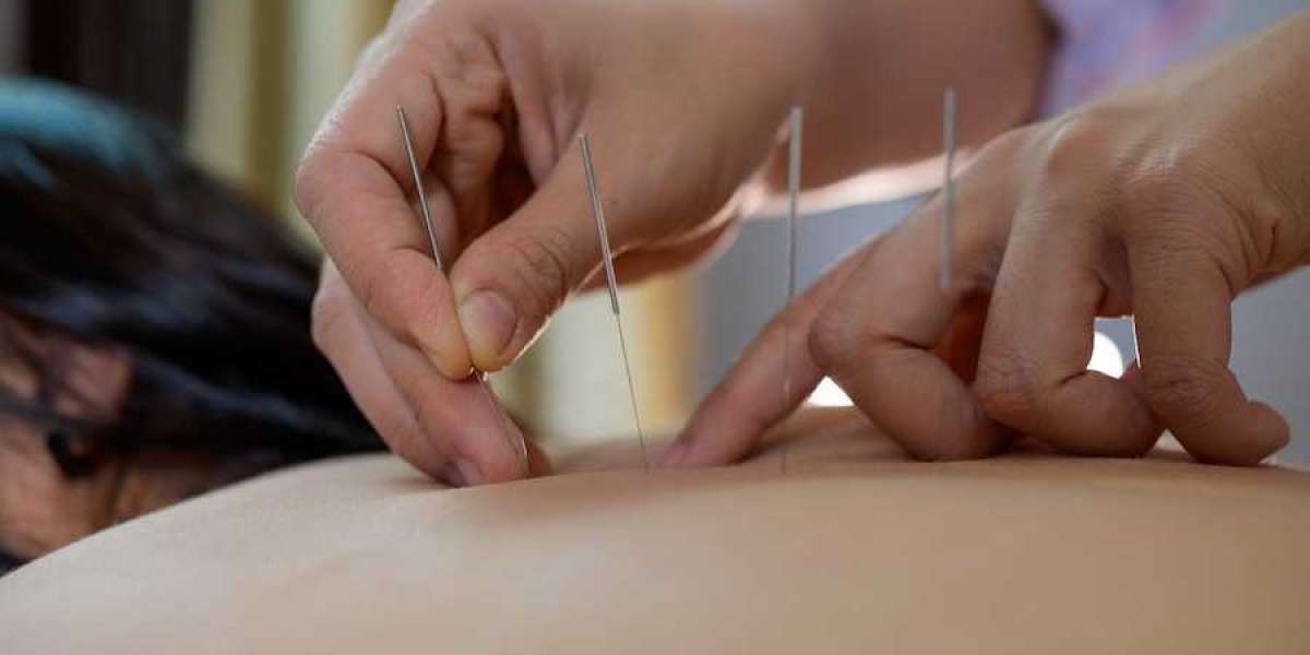 Benefits Of Acupuncture In Morristown You Must Consider