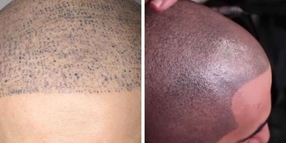 Scalp Micropigmentation for Hair Thinning: Reversing the Signs of Aging