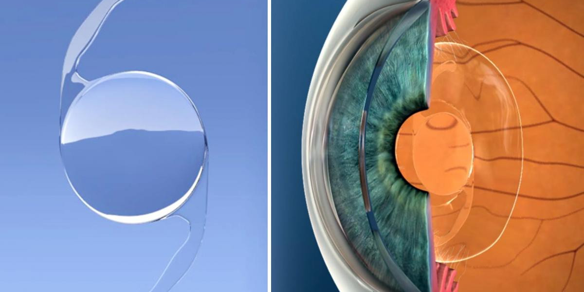 Beyond Cataract Surgery: Innovation Drives Intraocular Lens Market Expansion