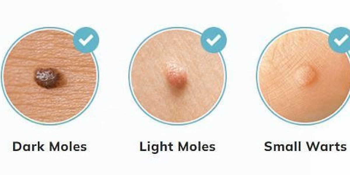 Full Body Skin Tag Remover USA: How Does It Work to Bid Farewell to Skin Tags?