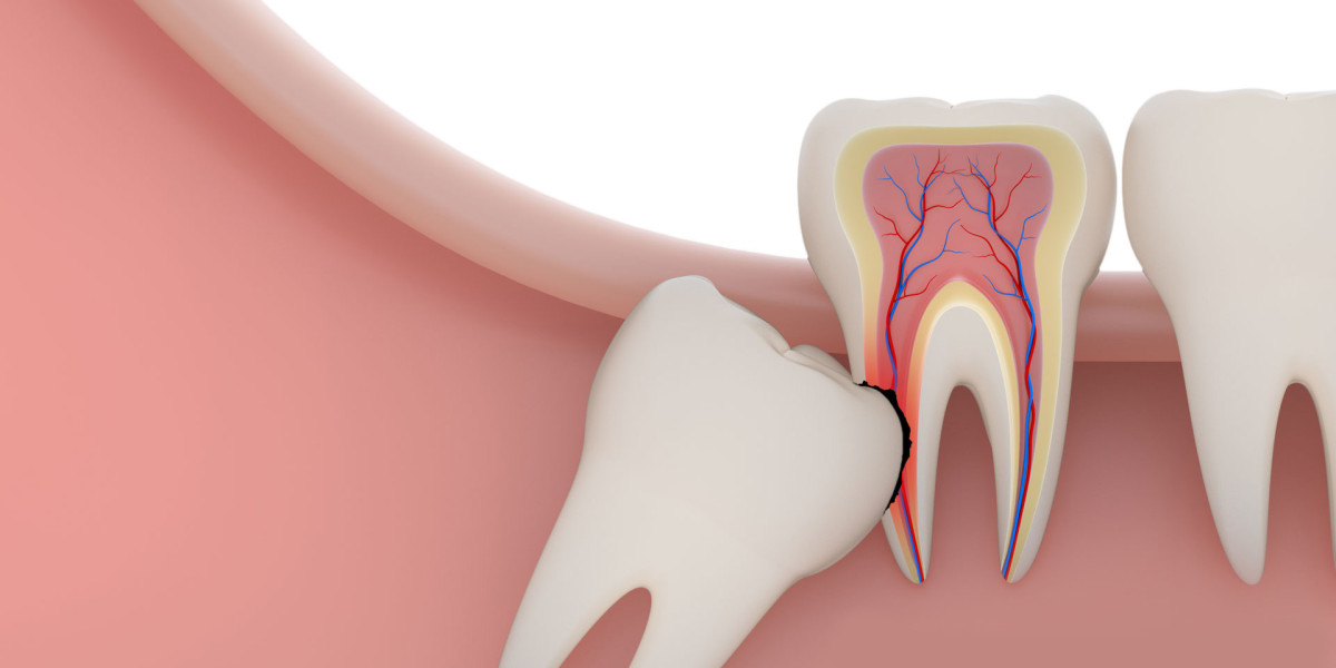 Is Wisdom Teeth Removal Necessary? Pros And Cons