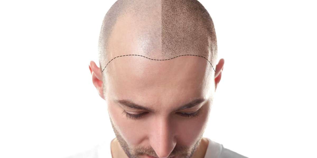 The Science Behind Scalp Micro Pigmentation: How It Works