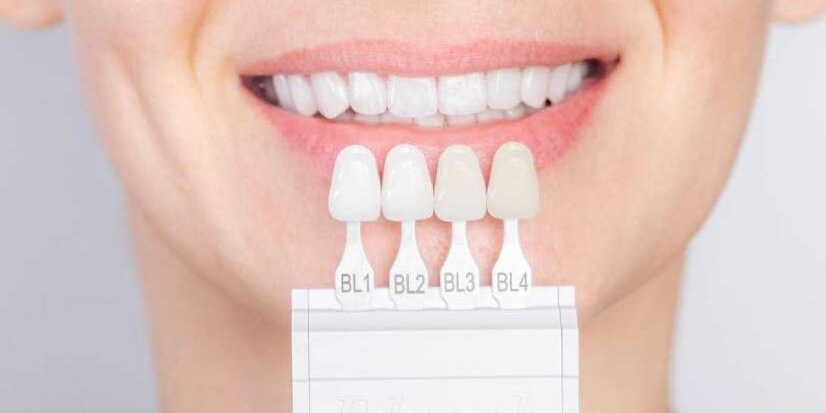 Enhance Your Smile with Porcelain Veneers: A Comprehensive Guide