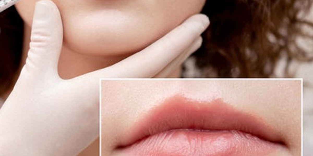 The Safety Considerations and Potential Risks of Medical Lip Filler Treatment