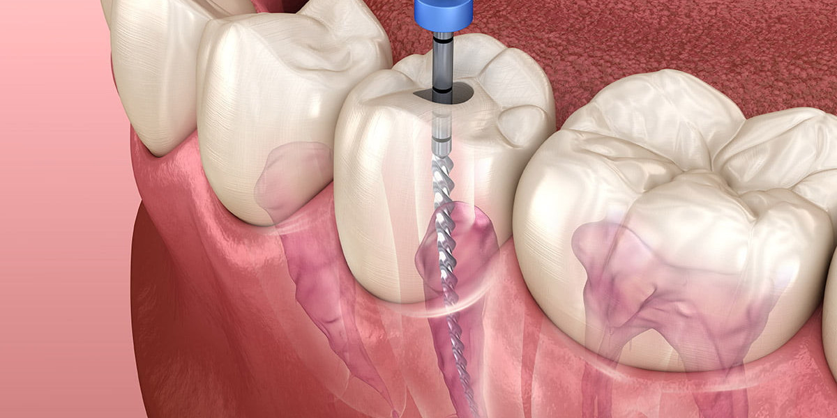 Root Canal Files: Essential Tools for Precise and Effective Endodontic Treatment