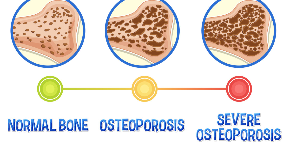 Osteoporosis: What You Need to Know