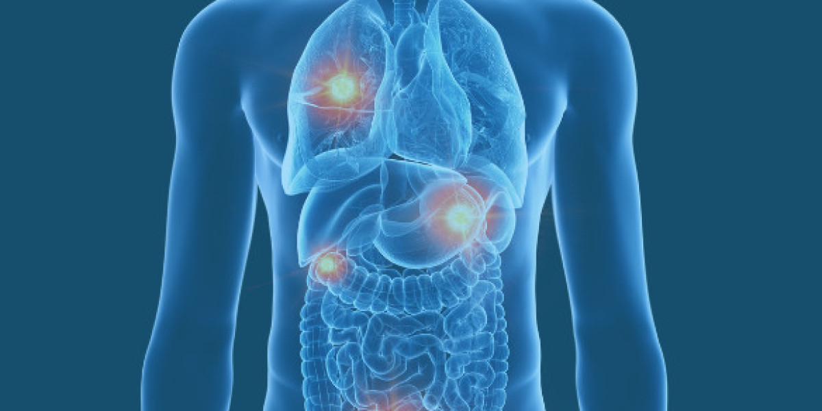 Exploring the Ripple Effects of Metastatic Cancer on the Body
