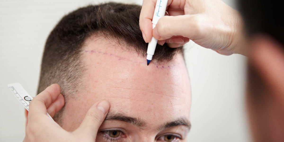 Choosing The Right Global Hair Transplant System For You