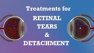 Advanced Treatments for Retinal Detachment and Tears | Eye Care Services | ASG Eye Hospital
