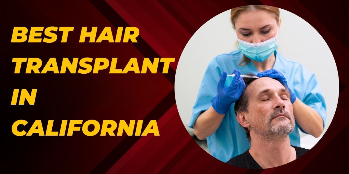 Quality Care: The Best Hair Transplant in California