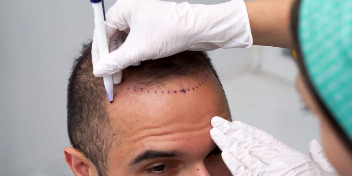 The Rise of Global Hair Transplant Systems: Trends and Innovations