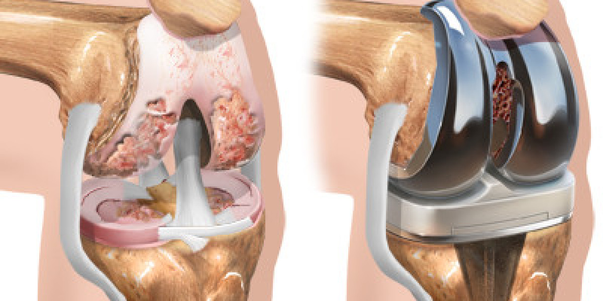 Knee Implants Market 2023 Overview, Growth Forecast, Demand and Development Research Report to 2031