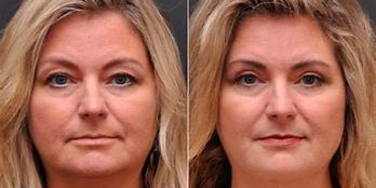 Blepharoplasty: A wide Manual in order to Eyelid Surgical treatment