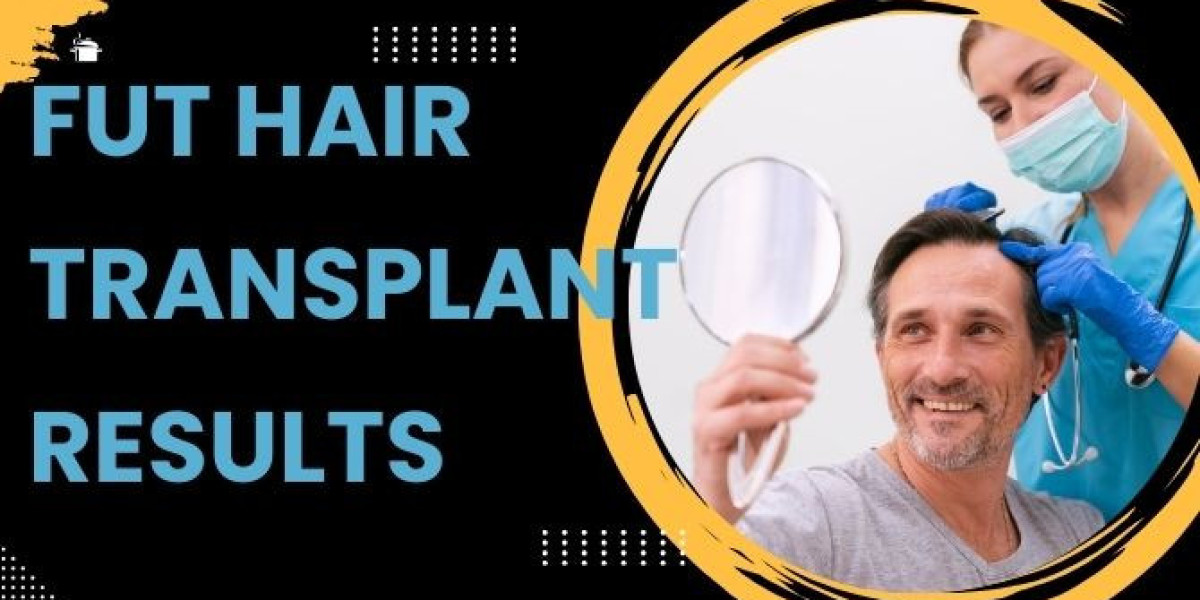 Unveiling the Marvels: FUT Hair Transplant Results Redefining Confidence and Beauty