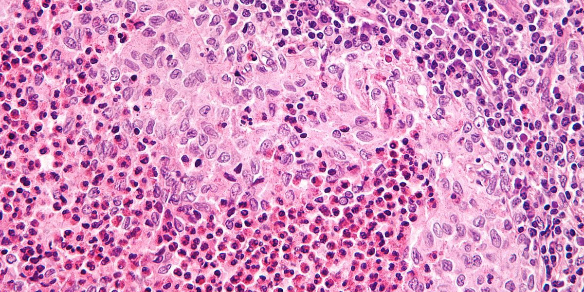 Langerhans Cell Histiocytosis Market Size, Share, Forecast and  Trends 2024-2034