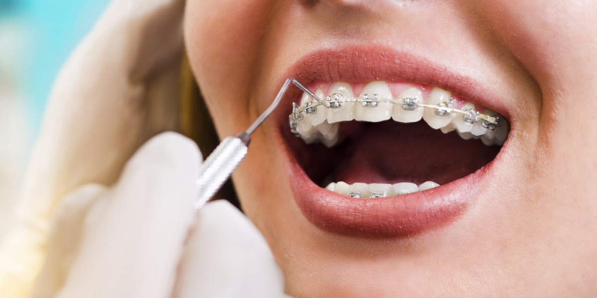 Global Orthodontic Brackets: Revolutionizing Treatment Approaches and Patient Care Worldwide