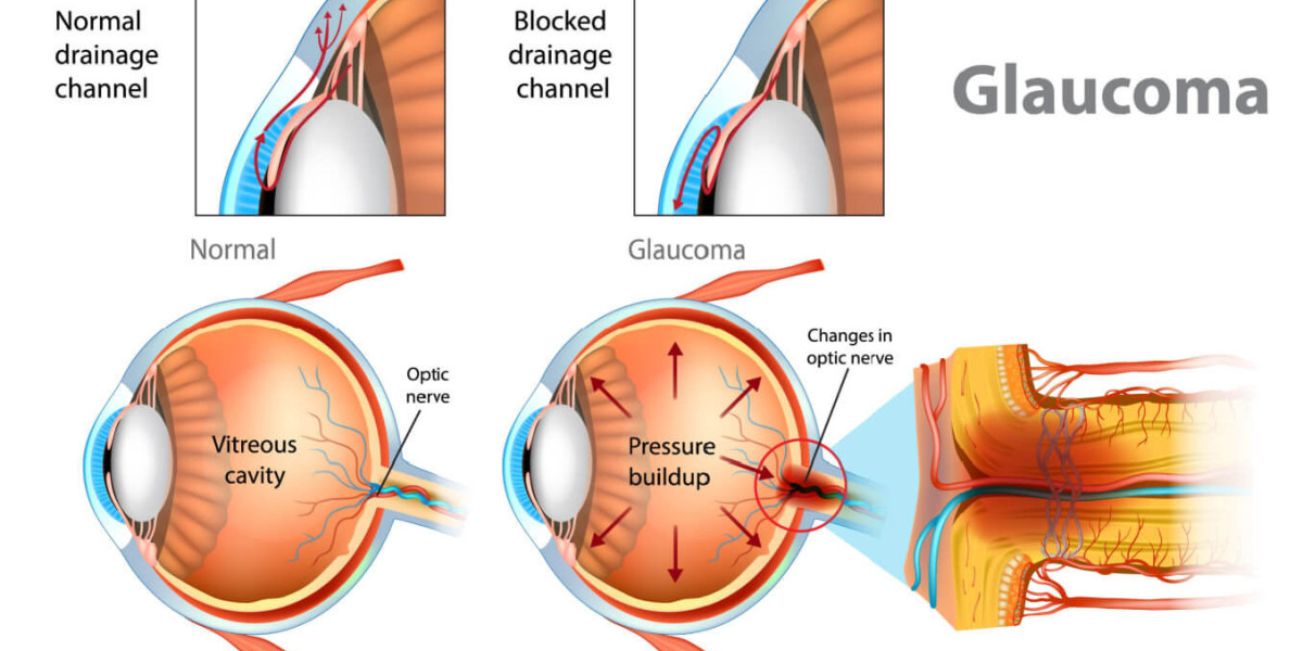 Glaucoma Market Size, Share & Trends Analysis Report 2033