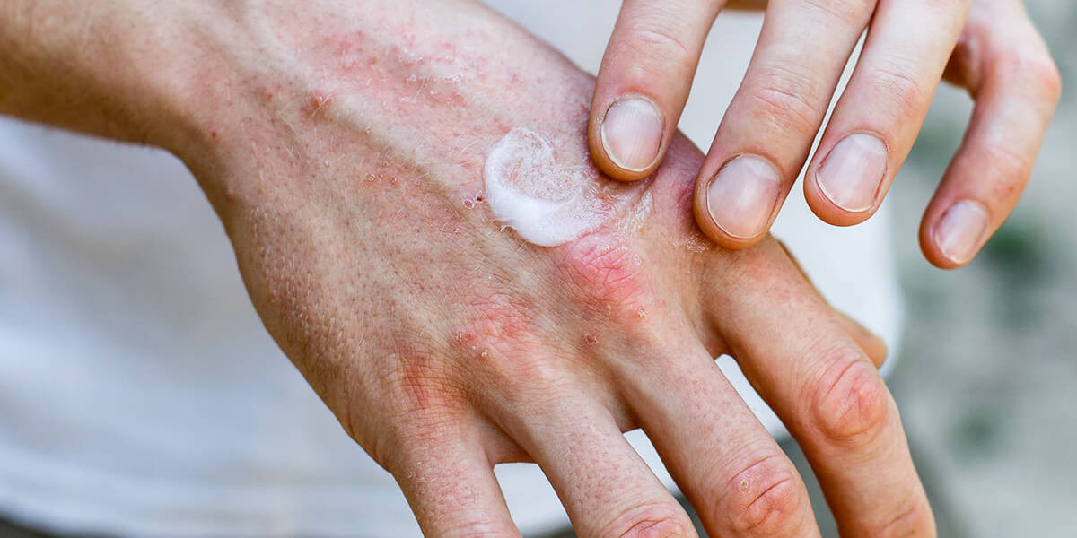Eczema Therapeutics Market is Poised to Expand at a Robust Pace by 2031