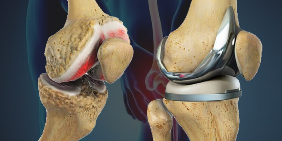 Reshaping Tomorrow: Insights into Advancements in Knee Replacement