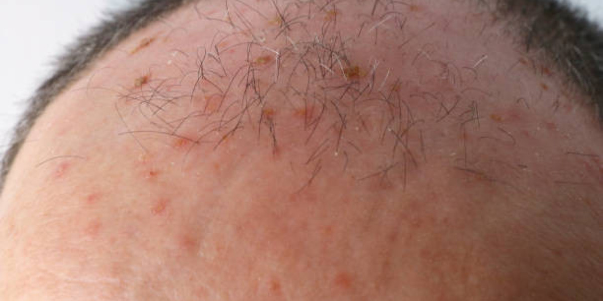 Insights into the Global Actinic Keratosis Market: Challenges and Opportunities