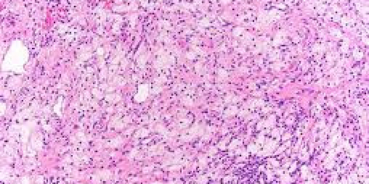Erdheim-Chester Disease Market Size, Analysis, Industry Statistics and Latest Insights Till 2034