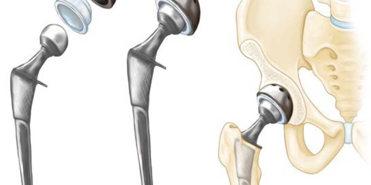 Hip Replacement Market Poised to Register Strong Growth Due to Rising Geriatric Population