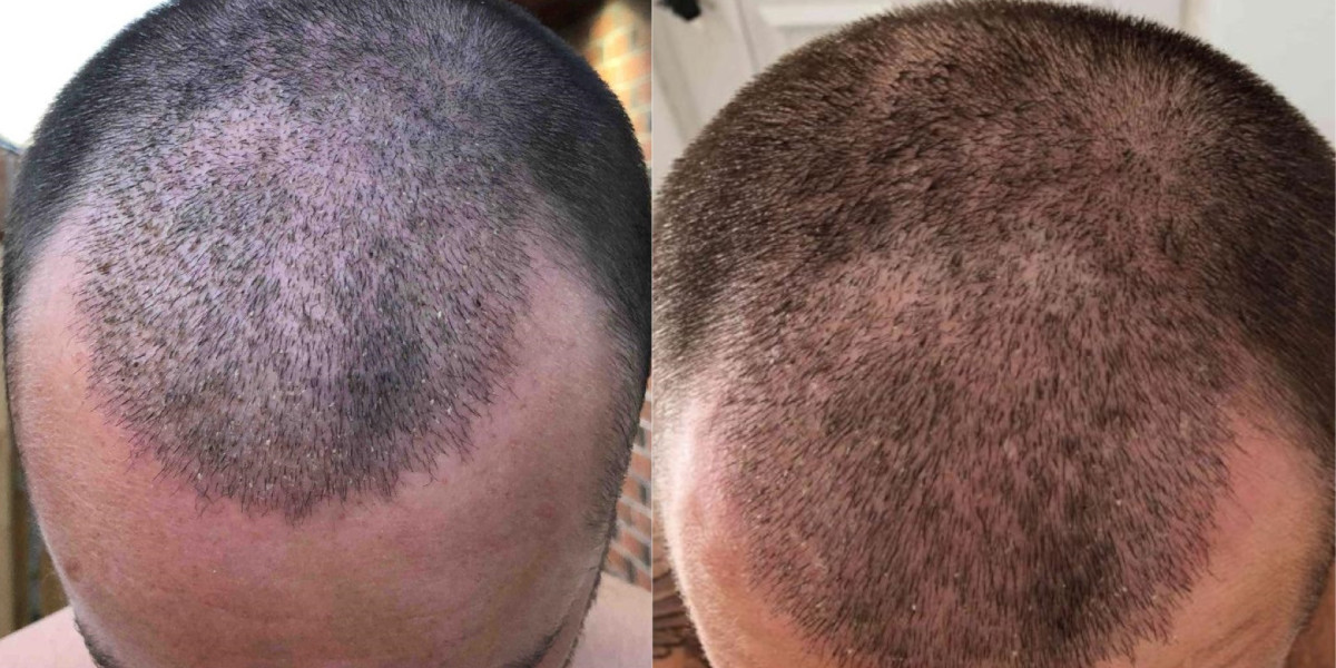 Progress Check: 12 Days After Hair Transplant