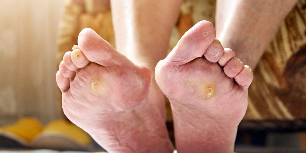 Diabetic Foot Ulcers Treatment Market is Estimated to Witness High Growth owing to Increasing Prevalence of Diabetes