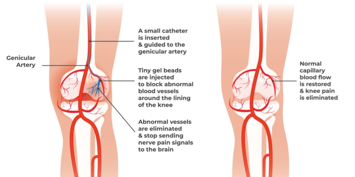 Understanding Genicular Artery Embolization: A Comprehensive Guide by Flowcare