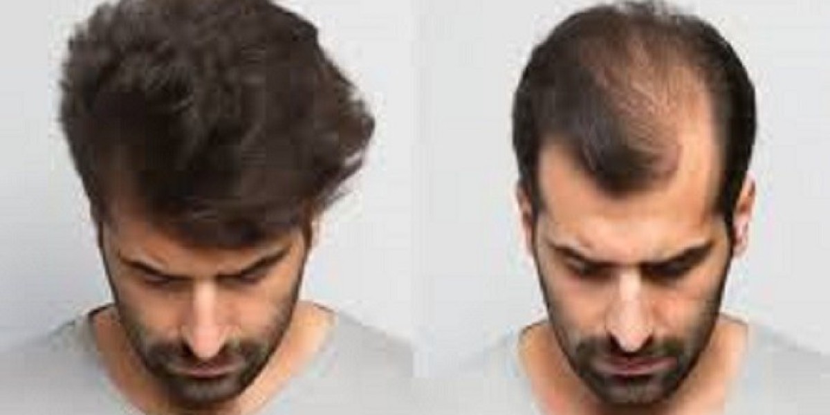 Transform Your Look with Advanced Hair Transplant Procedures in Riyadh