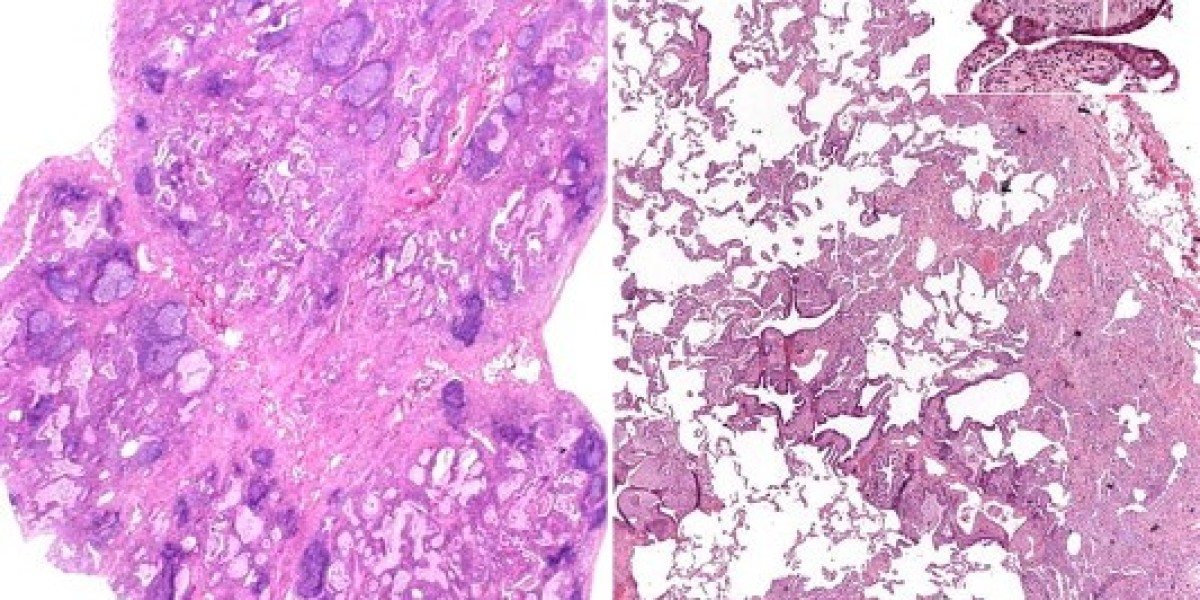 Idiopathic Pulmonary Fibrosis (IPF) Market Analysis, Epidemiology, Trends and Forecast till 2024-2034