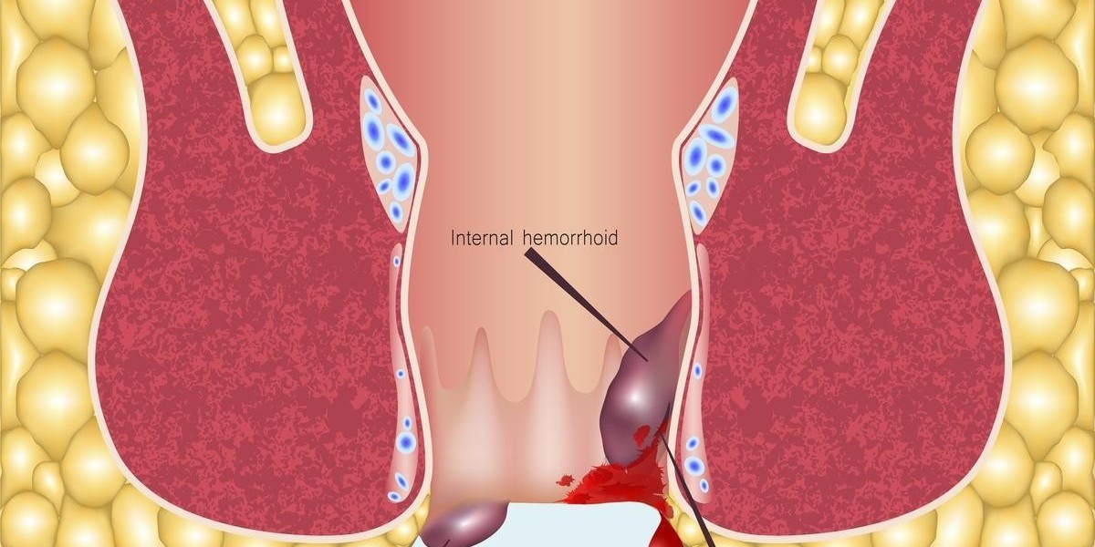 Hemorrhoids Market 2024: Epidemiology, Industry Trends, Opportunity and Forecast by 2034