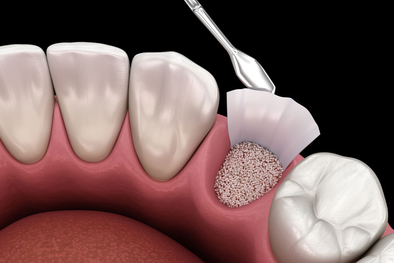 Bone Grafting Louisville, KY | Advanced Implant Centers | Treat Bone Loss