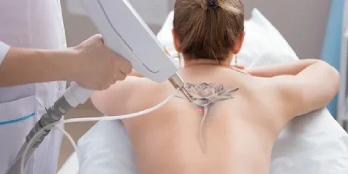 Laser Tattoo Removal in Riyadh: Everything You Need to Know